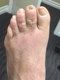 surgical treatment of hammer toes in the New York Mills, Utica, NY 13417 area