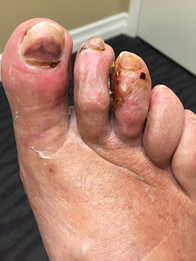 Non Surgical Treatment of Foot Gangrene
