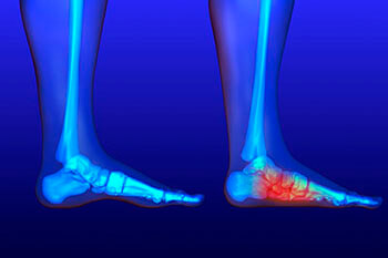 Flat feet and Fallen Arches treatment in the New York Mills, Utica, NY 13417 area