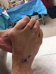 Bunion Surgery, Hammertoe Surgery in the New York Mills, Utica, NY 13417 area