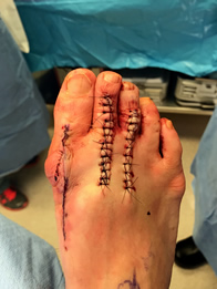 Foot and Ankle Reconstructive Surgery in the New York Mills, Utica, NY 13417 area