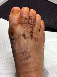 Foot and Ankle Reconstructive Surgery Result