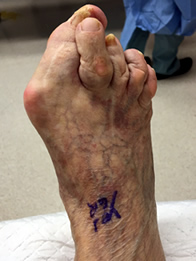 Bunion Surgery, Hammertoe Surgery in the New York Mills, Utica, NY 13417 area