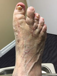 Foot and Ankle Reconstructive Surgery Result