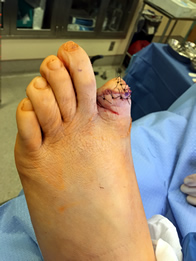 Surgical Treatment of the Infected Diabetic Foot in the New York Mills, Utica, NY 13417 area