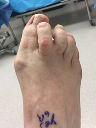 Foot reconstruction surgery in the New York Mills, Utica, NY 13417 area