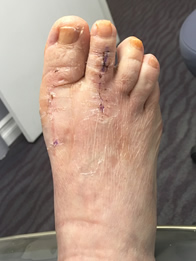 Foot Reconstructive Surgery in New York Mills, Utica, NY 13417