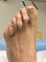 Hammertoe Surgical Treatment in Utica, NY