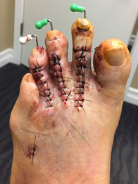 Minimally Invasive Hammertoe Surgery in the New York Mills, Utica, NY 13417 area