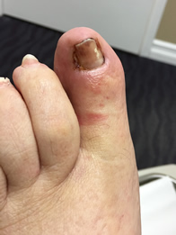 Ingrown Toenail Treatment New York Mills, Utica, NY 13417