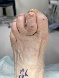 Bunion Surgery Before Bunion Surgery, Hammertoe Surgery in the New York Mills, Utica, NY 13417 area