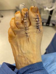 Foot and Ankle Reconstructive Surgery Foot and Ankle Reconstructive Surgery in the New York Mills, Utica, NY 13417 area