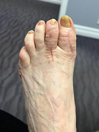Foot and Ankle Reconstructive Surgery After Foot and Ankle Reconstructive Surgery Result