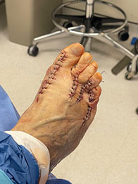 Foot and Ankle Reconstructive Surgery Foot and Ankle Reconstructive Surgery in the New York Mills, Utica, NY 13417 area