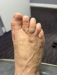 Foot and Ankle Reconstructive Surgery After Foot and Ankle Reconstructive Surgery Result