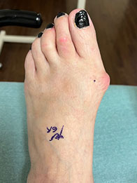 Bunion Surgery Before Bunion Surgery, Hammertoe Surgery in the New York Mills, Utica, NY 13417 area