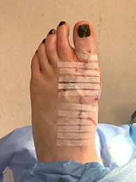 Foot and Ankle Reconstructive Surgery Foot and Ankle Reconstructive Surgery in the New York Mills, Utica, NY 13417 area