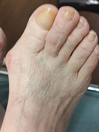 Bunion Surgery Before Bunion Surgery, Hammertoe Surgery in the New York Mills, Utica, NY 13417 area