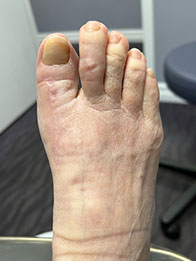 Foot and Ankle Reconstructive Surgery After Foot and Ankle Reconstructive Surgery Result