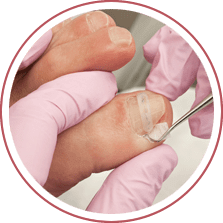 Ingrown Toenails Treatment in the New York Mills, Utica, NY 13417 area