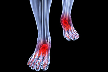 arthritic foot and ankle care treatment in the New York Mills, Utica, NY 13417 area
