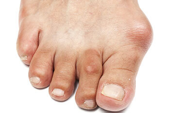 Bunions Removal, Surgery & Alternatives, Treatment & Recovery in the New York Mills, Utica, NY 13417 area