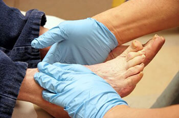 diabetic foot treatment in the New York Mills, Utica, NY 13417 area