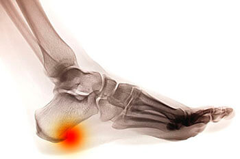 Heel spurs treatment in the New York Mills, Utica, NY 13417 area