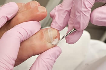 Ingrown toenails treatment in the New York Mills, Utica, NY 13417 area