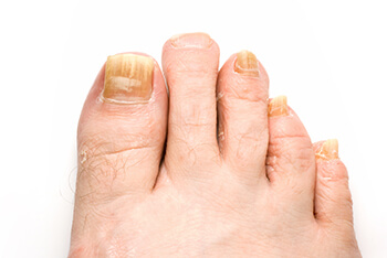 Fungal toenails treatment in the New York Mills, Utica, NY 13417 area