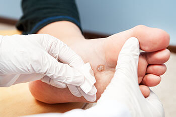 Plantar warts treatment in the New York Mills, Utica, NY 13417 area