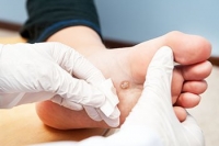 How Are Foot Warts Treated?
