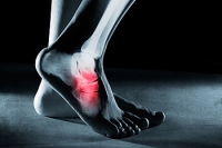 Don't Ignore a Stress Fracture