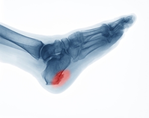 Are Heel Spurs the Underlying Cause of Your Heel Pain?