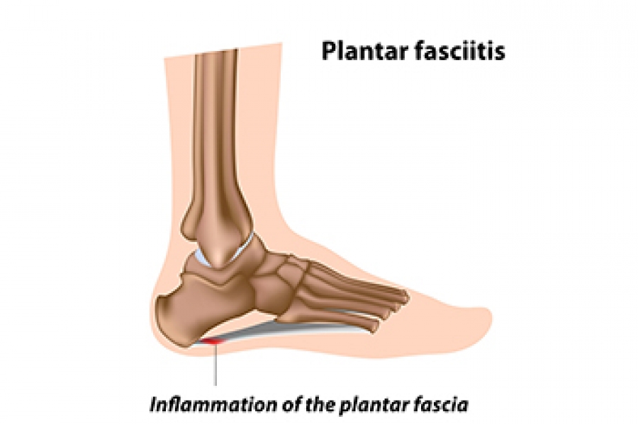 Plantar fasciitis child outlet