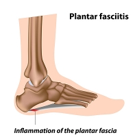 Is Plantar Fasciitis Painful?