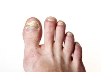 Toenail Fungus Is Common